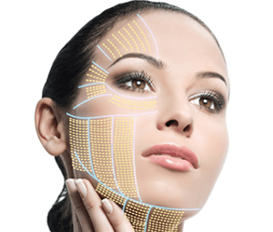 HIFU alt andlit + háls