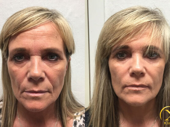 Ann-Askham-beint-fram-FILLER