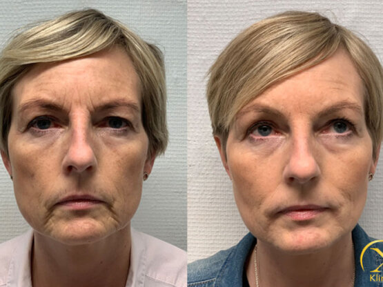 Anna-Maria-beint-fram-FILLLER