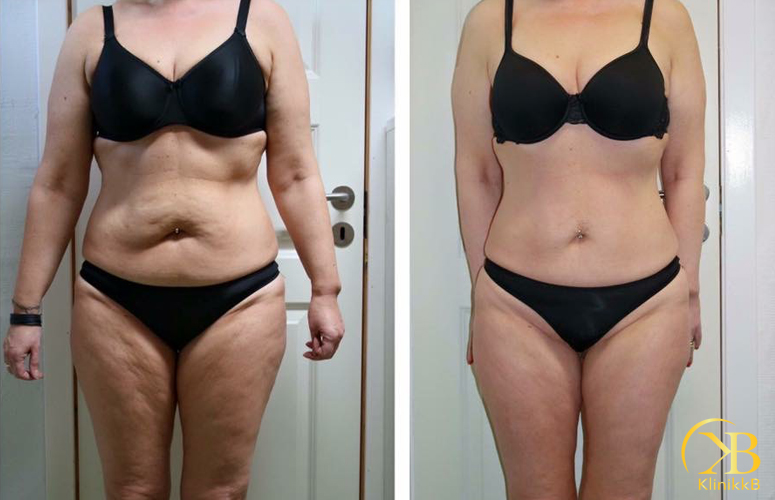 Annbritt Gerster FEITTFRYST+LPG