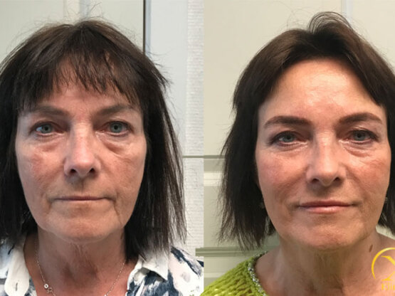 KATRIN-BEINT-FRAM-FILLER