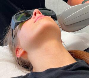 IPL Skin Rejuvenation