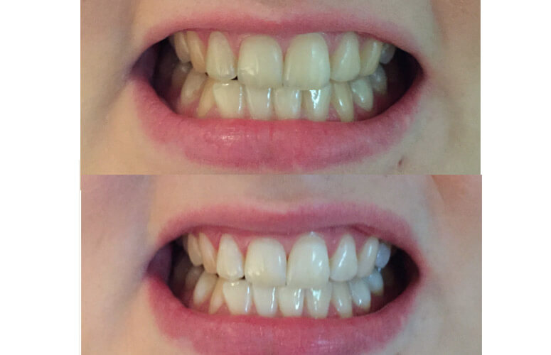 Tannbleiking før efter J