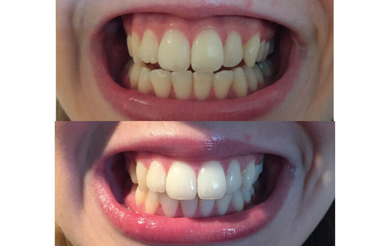 tannbleiking før efter soley