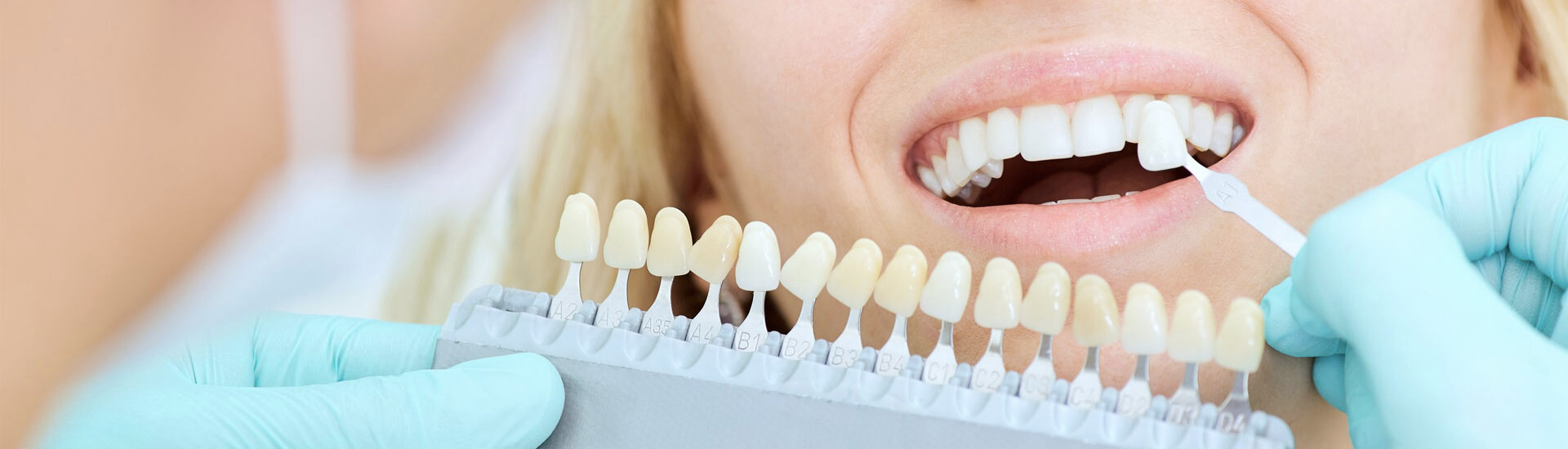 tannbleiking topp kvinna