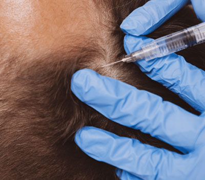 Tricology til hártap