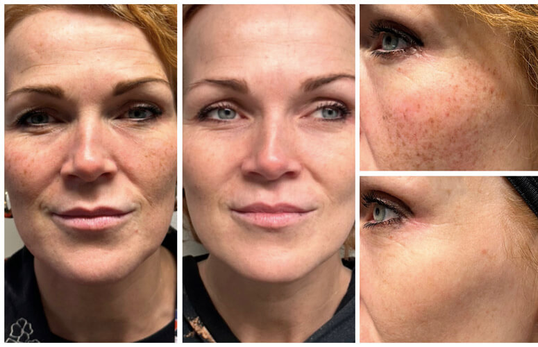 Herborg Torkilsdóttir áðrenn og aftaná 1 IPL