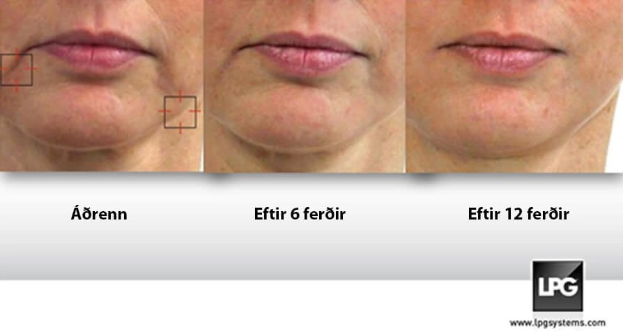 Áðrenn og aftaná Endermolift