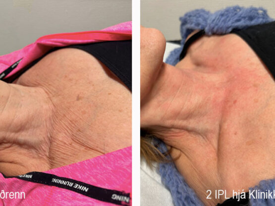 Birgith IPL dekollete