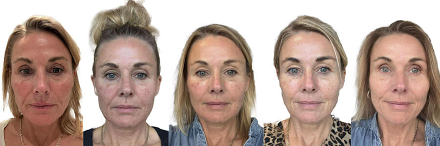 Her eru myndir av tilgongdini hjá Unn - mynd av dag 0, 1, 2, 3 & dag 14