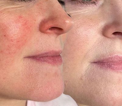 Rosacea