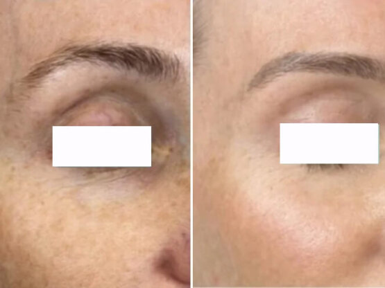 Før efter 775 x 500 1 x frax 1940