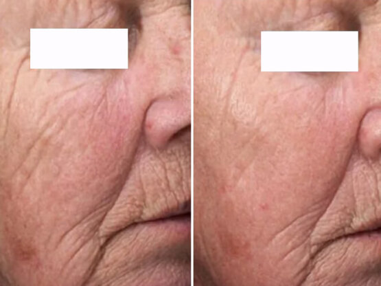 Før efter 775 x 500 2 dual frax