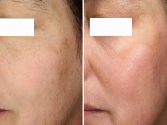 Før efter 775 x 500. 3 x frax 1940