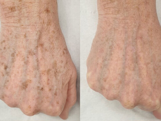 Ikke-navngivet-10.jpg 1 x dual frax ho