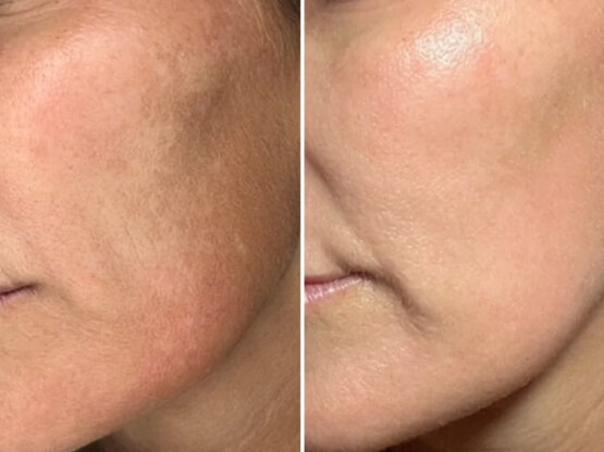 Ikke-navngivet-10.jpg 1 x dual frax si