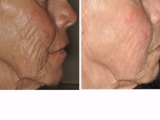 Ikke-navngivet-11. 2 x frax 1550