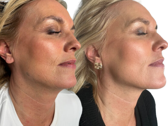 Ikke-navngivet-11.jpg Mold hals