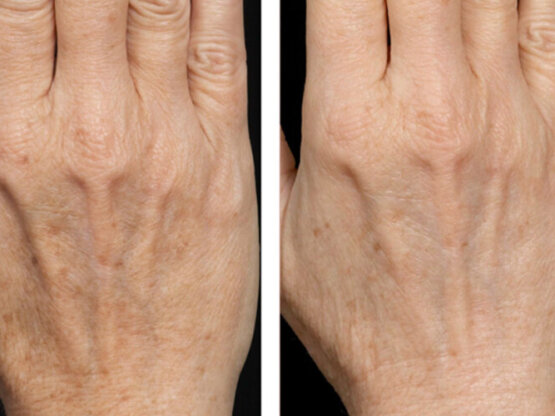 Ikke-navngivet-12.dual frax x 2 hendur