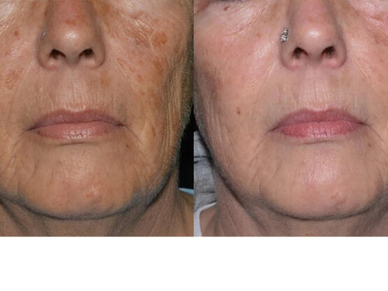 Ikke-navngivet-12.frax 1550