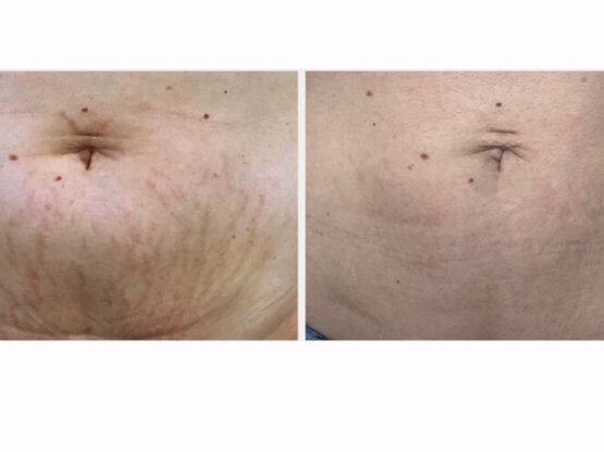 Ikke-navngivet- 2 x frax 1550 strekk