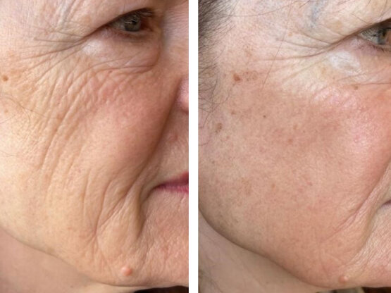 Ikke-navngivet-8.jpg dual frax x1