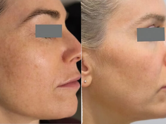 Før efter 775 x 500.jpg 1 x 1940 b