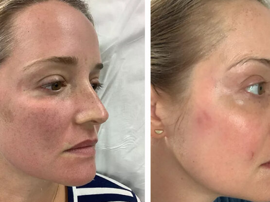 Før efter 775 x 500.jpg 1940 dag 1 og 5