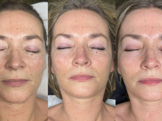 Før efter 775 x 500.jpg Anna Marita 1 og 2 light and bright