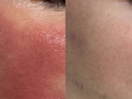 Før efter 775 x 500.jpg IPL nervøs rød