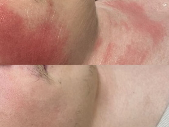 Før efter 775 x 500.jpg IPL nervøs rødme