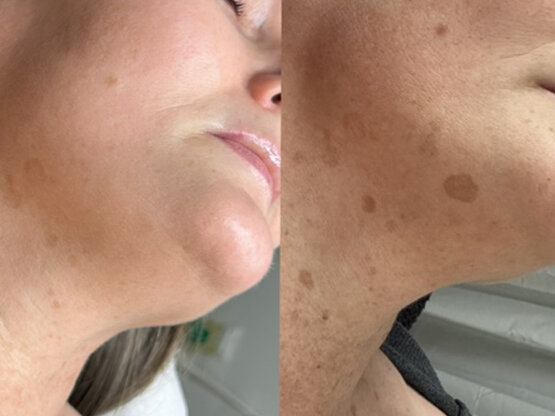 Før efter 775 x 500.jpg Irdi 1