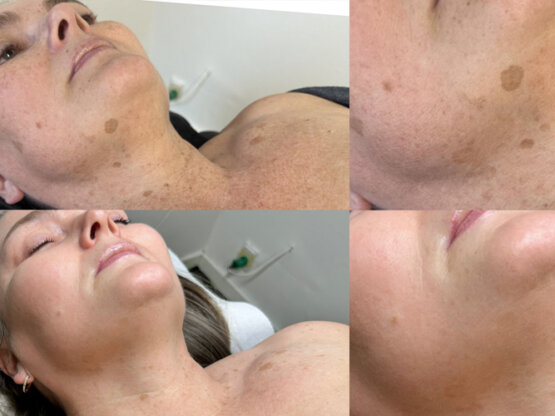 Før efter 775 x 500.jpg Irdi 7