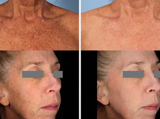 Før efter 775 x 500.jpg frax 1940 1 ovar 3 nidar