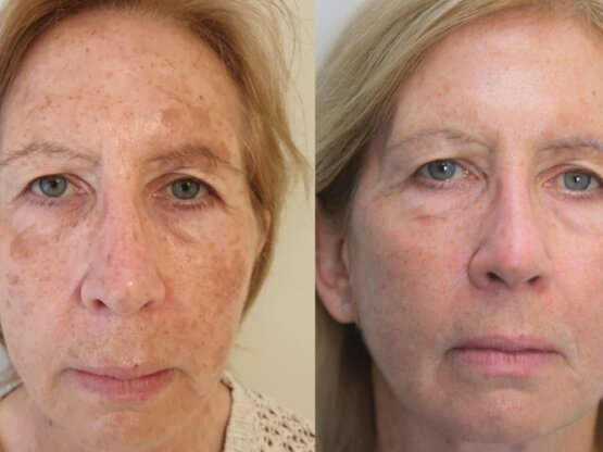 Før efter 775 x 500.jpg frax dual