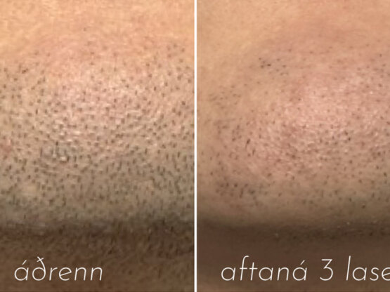 Før efter 775 x 500.jpg hár 1