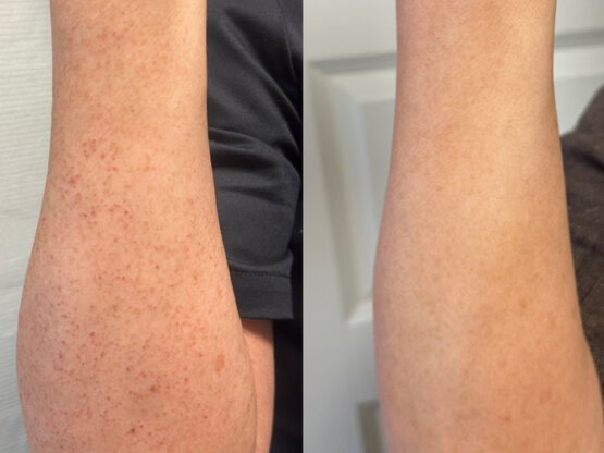 Før efter 775 x 500.jpg ipl arm bl