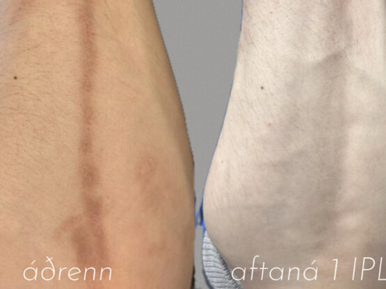 Før efter 775 x 500.jpg ipl arr