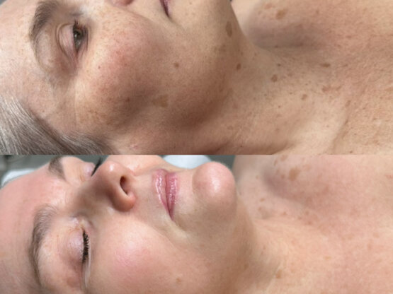 Før efter 775 x 500.jpg irdi 5