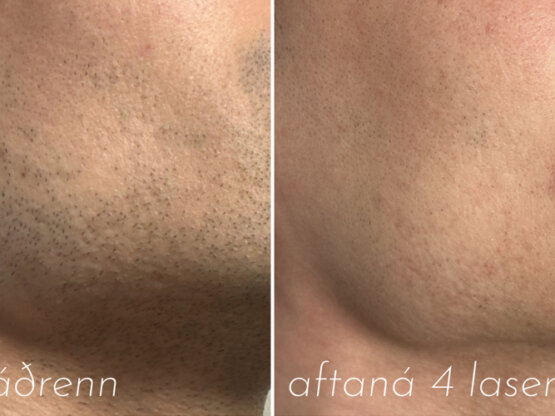 Før efter 775 x 500.jpg laser