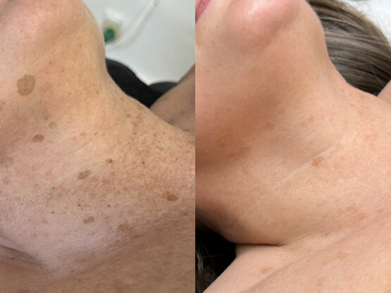 Ikke-navngivet-10.jpg irdi háls