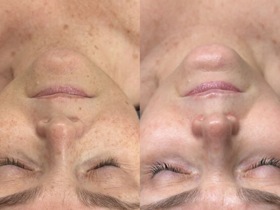 Ikke-navngivet-10.jpg iridi halvt høvd