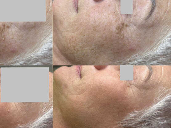 Ikke-navngivet-11.jpg ipl cryo