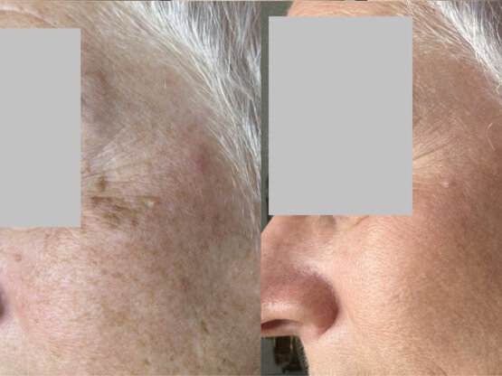 Ikke-navngivet-11.jpg iplcryo