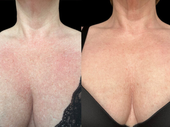 Ikke-navngivet-11.jpg Beinta ipl frax