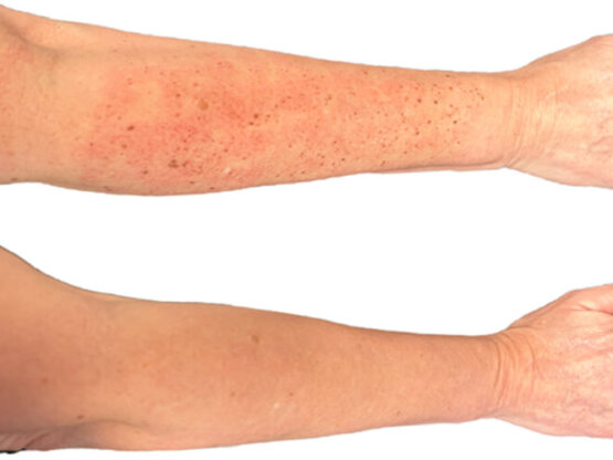 Ikke-navngivet-11.jpg ipl arm