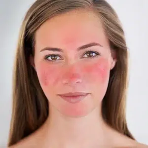 Reyða viðkvoma húð