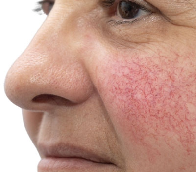 Rosacea og reyð húð