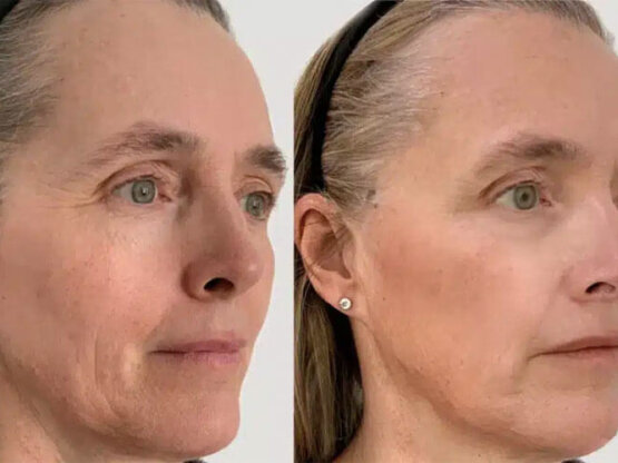 structura før efter